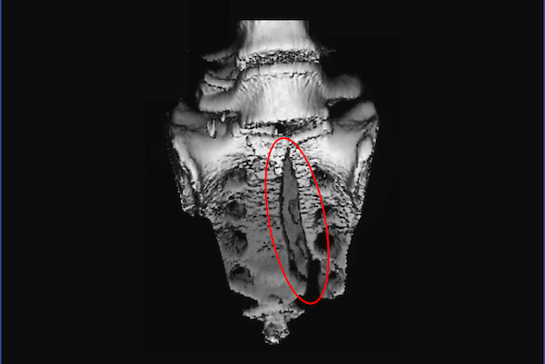 sacrum fracture and sex Big womans breasts